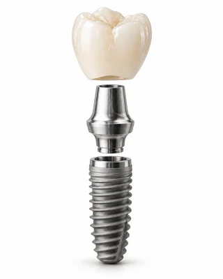 Beyaz zeminde implant gövdesi, bağlantı parçası ve seramik kron bileşenleri