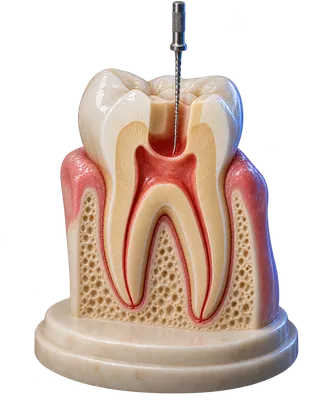 Kanal tedavisi konusuna ait temsili dental görsel