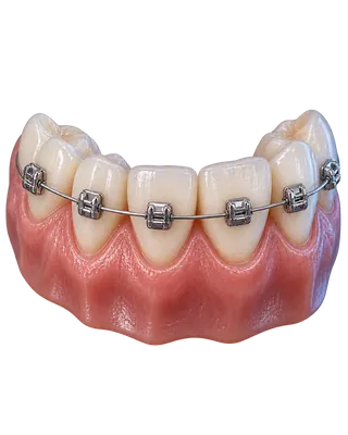 Ortodontik tedavi seçenekleri konusuna ait temsili dental görsel